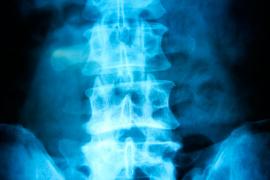 spine-tumor-facts.jpg