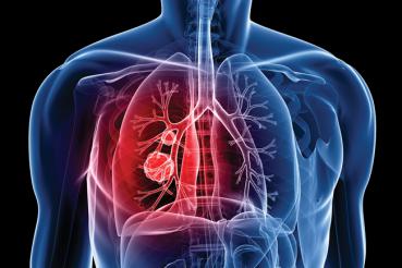lung cancer 