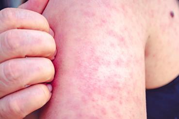 Woman with measles scratching arm